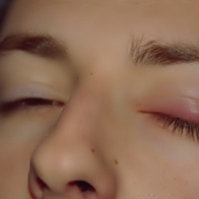 Тяжелые веки с чем связано Тяжелые веки с чем связано